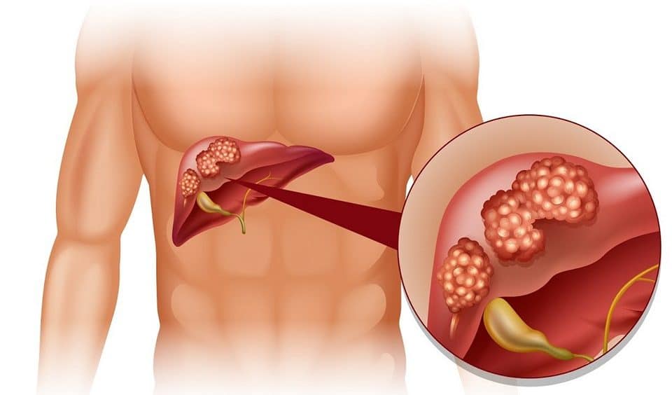 Билирубин в крови