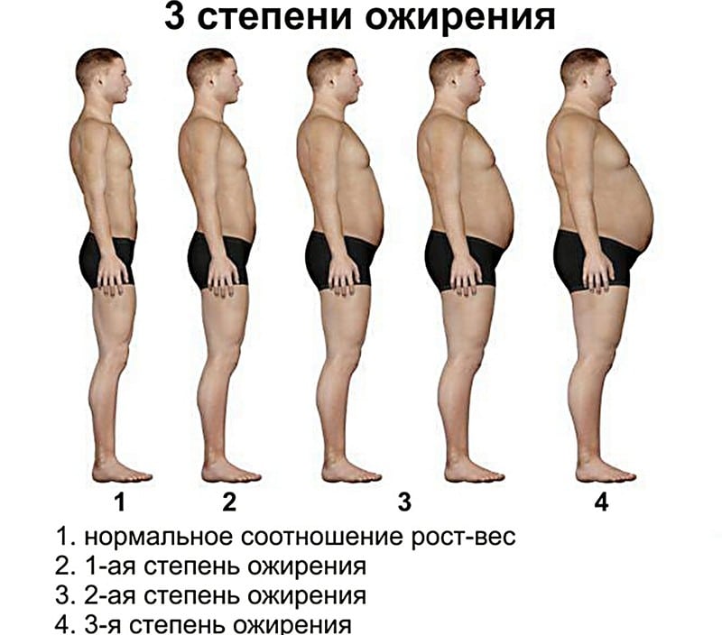 Степени ожирения у мужчин