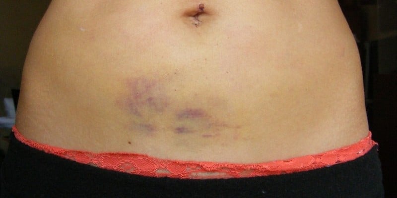 синяки после липосакции