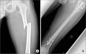 Остеосинтез бедра Остеосинтез диафизарного перелома бедра