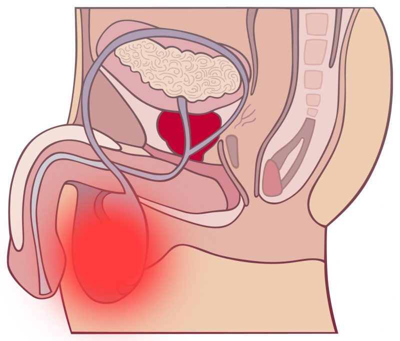 Воспаление яичек у мужчин