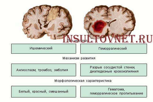 Виды инсульта