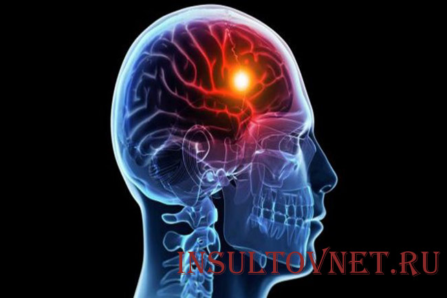 Особенности лакунарного инсульта