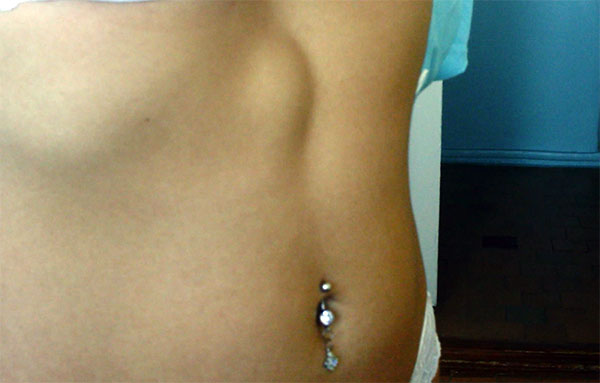 Грыжа кишечника - виды, причины развития, симптомы, способы лечения