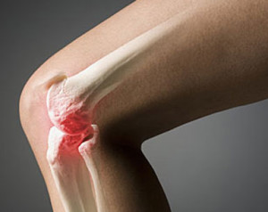 Остеомиелит кости Остеомиелит