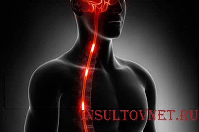 Спинальный инсульт