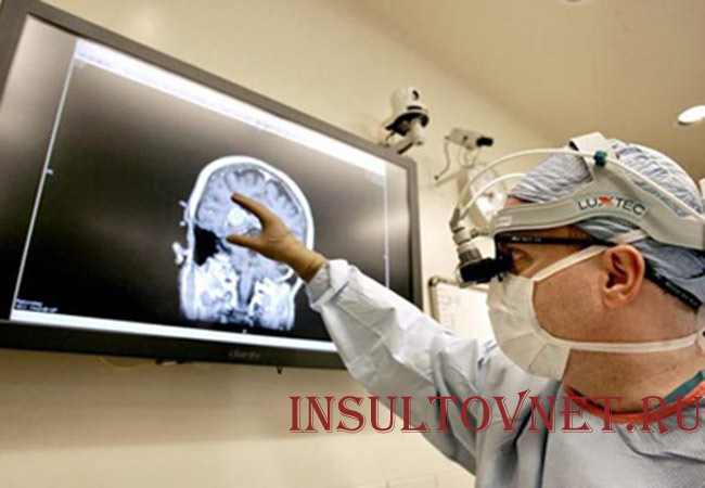 Опухоль головного мозга