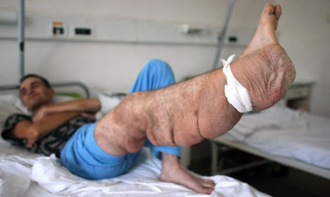 упражнения для оттока лимфы