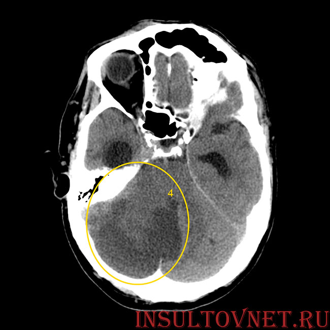 обширный инсульт