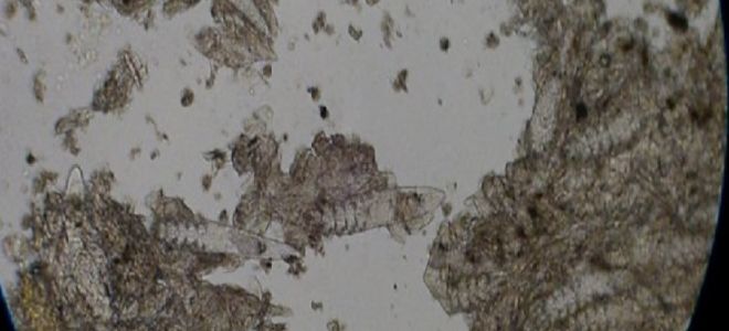 Как брать соскоб на наличие яйцеглистов