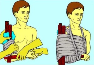 Первая помощь при переломах Порядок наложение шины