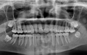 Рентгеновский снимок челюстей Воспалительный процесс, который приводит к развитию остеонекроза