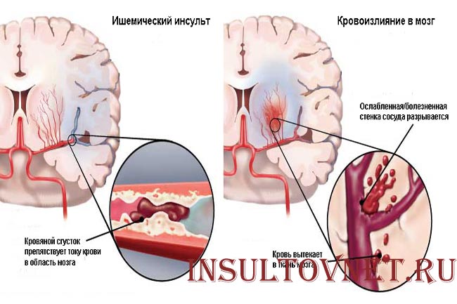 Виды инсультов