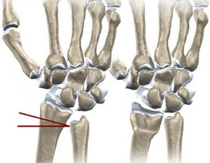 Кости запястья Короткая локтевая кость