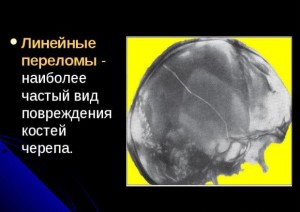 Рентген черепа Линейный перелом черепа
