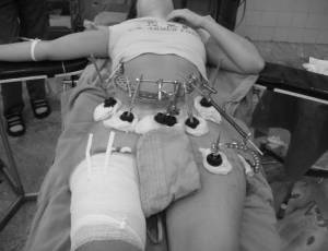 Остеосинтез таза Фиксация отломков костей с помощью остеосинтеза