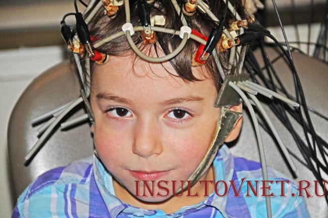 ЭЭГ головного мозга