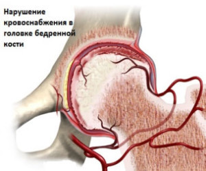 Болезнь Пертеса Нарушение кровочнабжения головки сустава