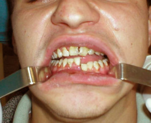 Переломом нижней челюсти Частичное нарушение целостности кости челюсти