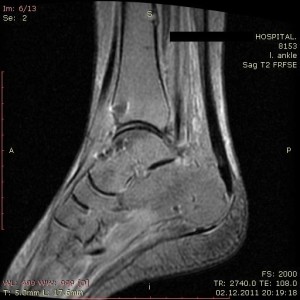 Есть ли некроз блока МРТ таранной кости