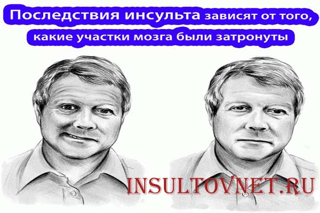 Последствия инсульта