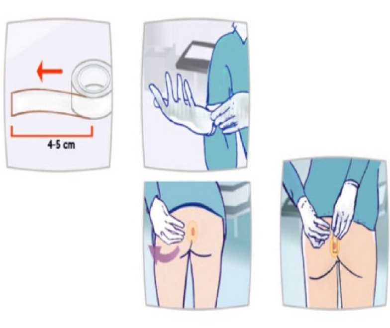 Как брать соскоб пошагово