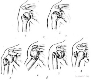 Переломы бугорков Типы бугорковых переломов