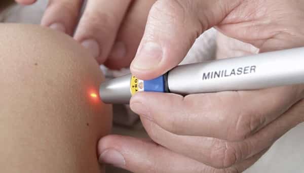 удаление папиллом лазером