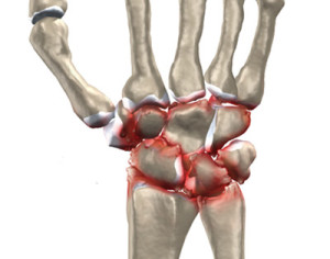 Поврежденные суставы запястья Артроз запястья