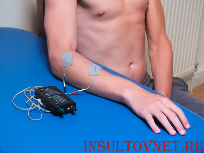 электростимуляция
