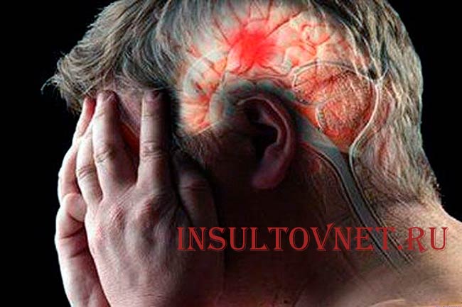 Инсульт у мужчин