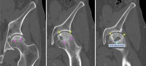 Стадии болезни Асептический некроз головки левой бедренной кости