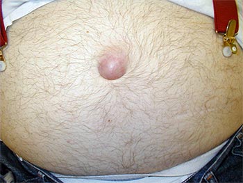 Лечение пупковых грыж у мужчин без последующих рецидивов