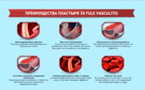 Преимущества пластыря 38 Fule Vasculitis