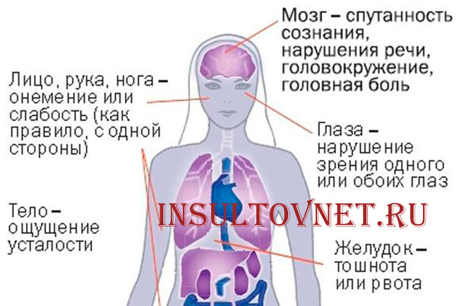 Симптомы инсульта