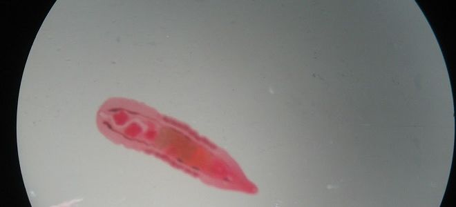 Симптомы, диагностика и лечение хронического описторхоза