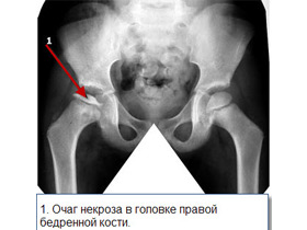Некроза сустава Лечение некроза тазобедренных суставов