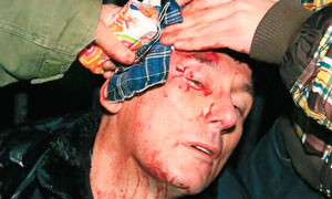 Мужчина с разбитой головой Перелом височной кости