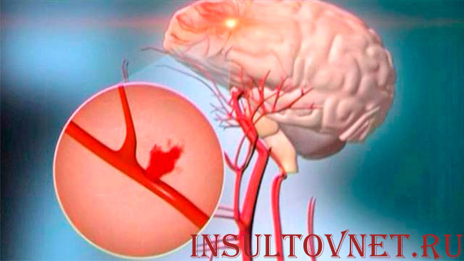 субарахноидальное кровоизлияние