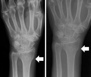 Рентген руки Перелом шиловидного отростка
