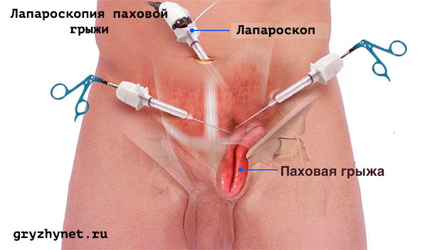 Бесспорные преимущества удаления паховой грыжи методом лапороскопии