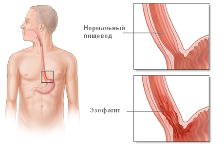 Эзофагит
