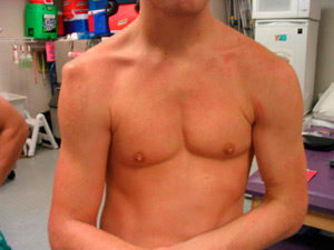 Привычный вывих плеча Симптомы привычного вывиха плеча