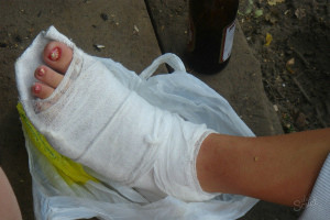 Гипсовая повязка на ноге При сложных вывихах используется повязка из гипса