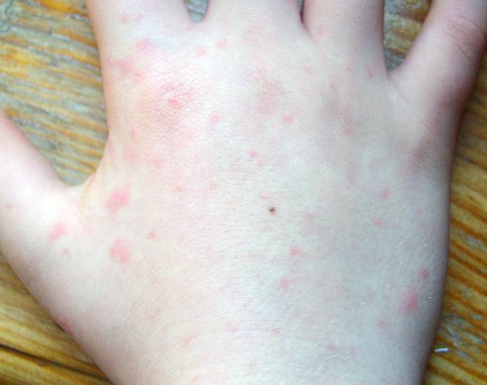 розовая сыпь у детей