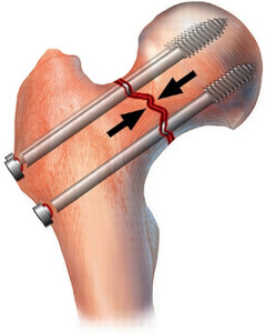 Остеосинтез шейки бедра Остеосинтез с использованием металлических винтов