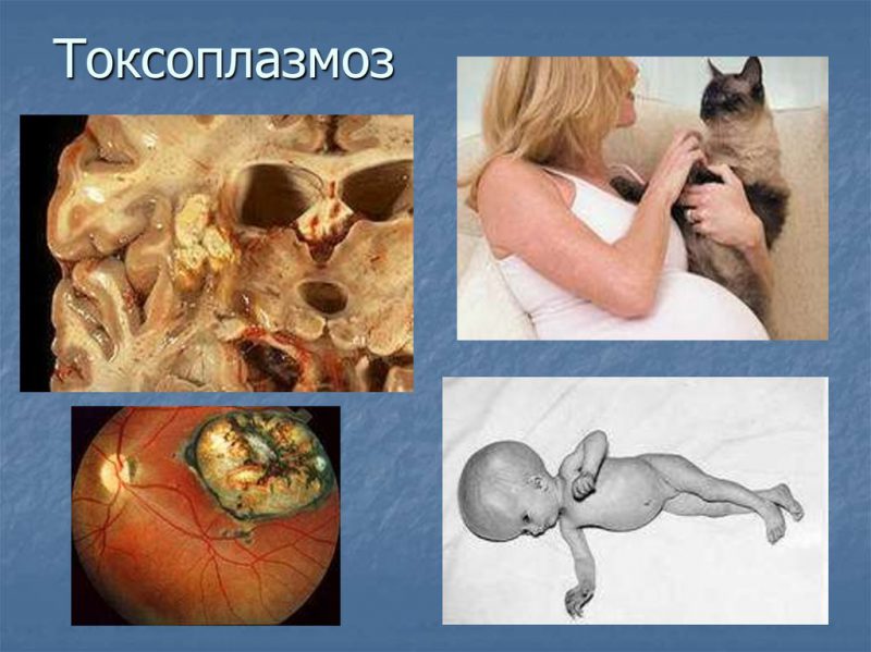 токсопламоз