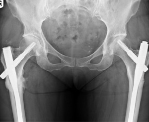 Блокированный остеосинтез Статический блокированный остеосинтез