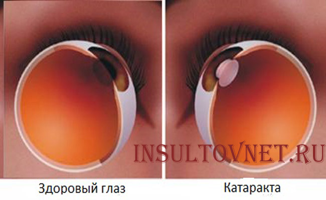 Катаракта