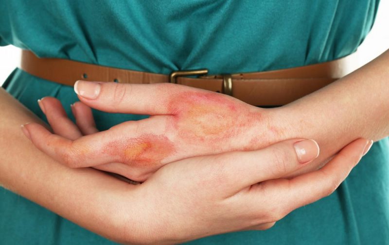 дерматит на руках